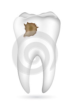 Cavity in Tooth