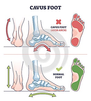 Cavus foot with abnormal high arch condition to feet bones outline diagram photo