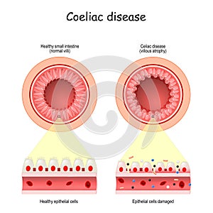 Celiac or Coeliac disease. leaky gut