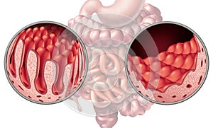 Celiac Coeliac Intestine Disease