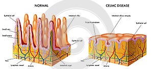 Celiac disease