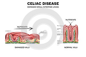 Celiac disease