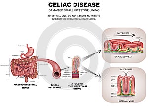 Celiac disease