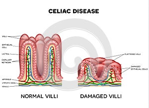 Celiac disease photo