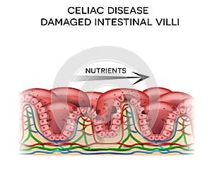 Celiac disease damaged intestine