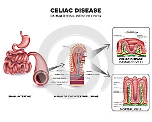 Celiac disease photo