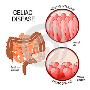 Celiac disease. small intestinal with normal villi, and villous