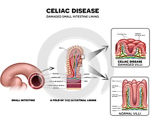 Celiac disease Small intestine lining damage