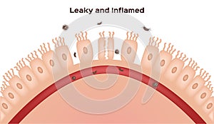 Celiac disease Small intestine lining damage. good and damaged villi . leaky gut progression