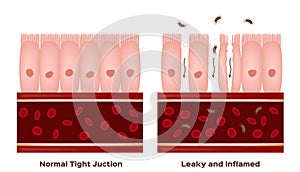 Celiac disease Small intestine lining damage. good and damaged villi . leaky gut progression