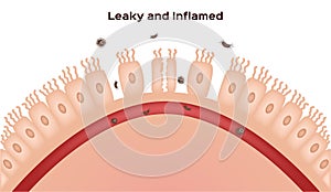 Celiac disease Small intestine lining damage. good and damaged villi . leaky gut progression photo