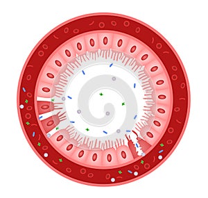 Celiac disease Small intestine lining damage. good and damaged villi . leaky gut progression