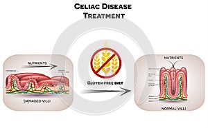 Celiac disease treatment gluten free diet