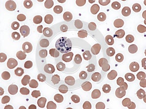 Cell in apoptosis in peripheral blood.