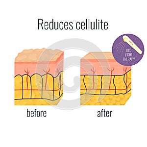 Cell illustration with cellullite and without.