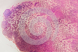 Cell microscopic- lymph node