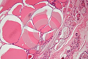 Cells of a human thyroid gland with swelling under a microscope