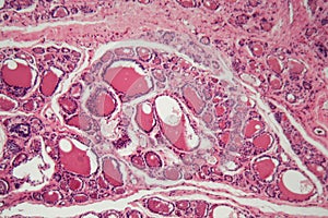 Cells of a human thyroid gland with swelling under a microscope
