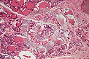 Cells of a human thyroid gland with swelling under a microscope