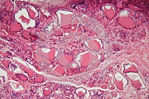 Cells of a human thyroid gland with swelling under a microscope