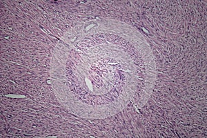 Cells of human uterus tissue with inoffensive tumor cells