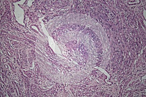 Cells of human uterus tissue with inoffensive tumor cells