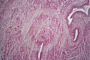 Cells of a human uterus with uterine fibroids