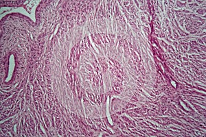 Cells of a human uterus with uterine fibroids