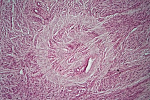 Cells of a human uterus with uterine fibroids