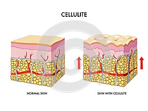 Cellulite