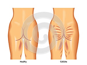 Cellulite