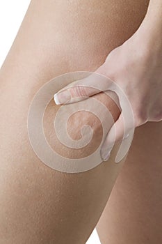 Cellulite photo