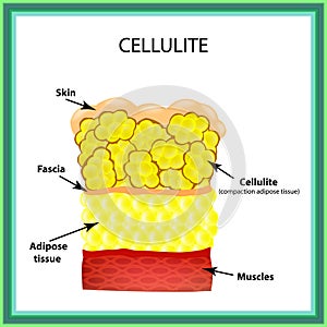 Cellulite. The anatomical structure of the adipose tissue. Infographics. Vector illustration on isolated background