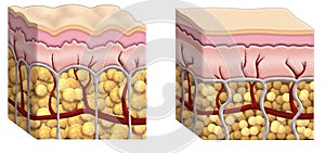 Cellulite cross section photo