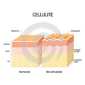 Cellulite. Cross section of a healthy skin and skin with Orange peel