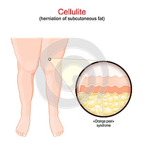 Cellulite. Females legs. human skin with Orange peel syndrome