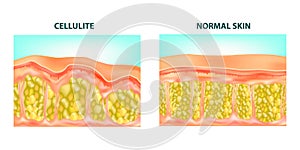 Cellulite formation.