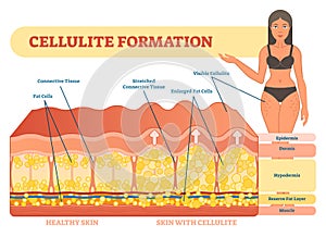 Cellulite formation vector illustration diagram, medical information scheme.