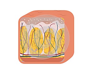 Cellulite formation vector illustration diagram, medical information scheme. Womans skincare. Flat vector illustration.