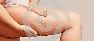 Cellulite leg woman pinch. Test fat hips treatment. Over weight
