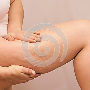 Cellulite leg woman pinch. Test fat hips treatment. Over weight liposuction