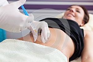 Cellulite mesotherapy