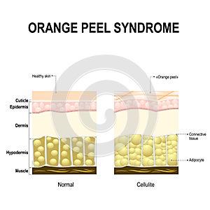 Cellulite or orange peel syndrome