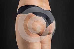 Cellulite problem concept, before and after