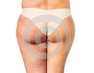 Cellulite problem concept, before and after photo
