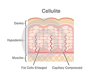 Cellulite`s skin vector illustration