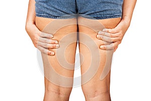 cellulite of a teenage girl. photo