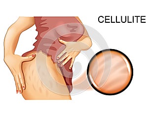 Cellulite on a woman`s thigh