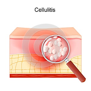 Cellulitis. bacterial infection of the fat through a magnifying glass photo