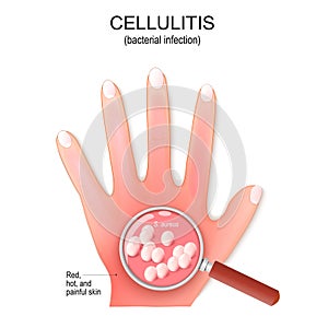 Cellulitis. Humans hand with bacterial infection photo